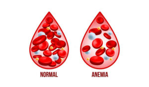 anemia perniciosa globulos plaquetas